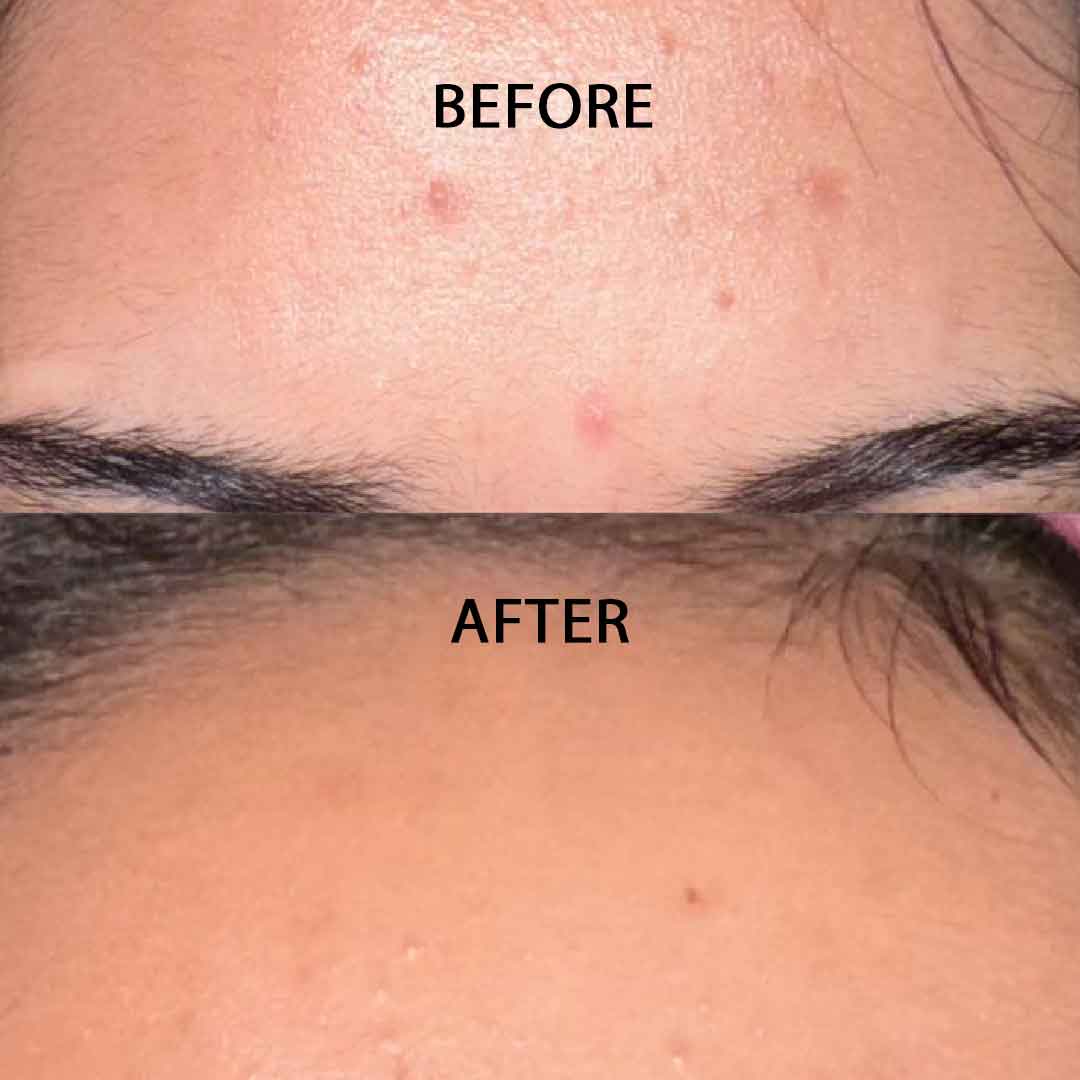 AHA BHA Exfoliating Treatment